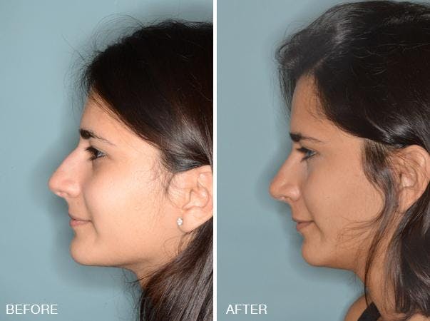 Rhinoplasty before and after, lateral left.