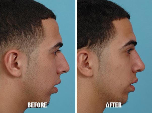 Rhinoplasty before and after, lateral right.