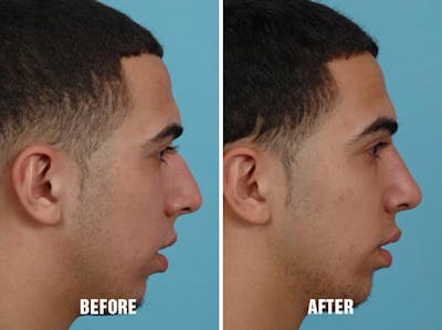 Rhinoplasty before and after, lateral right.