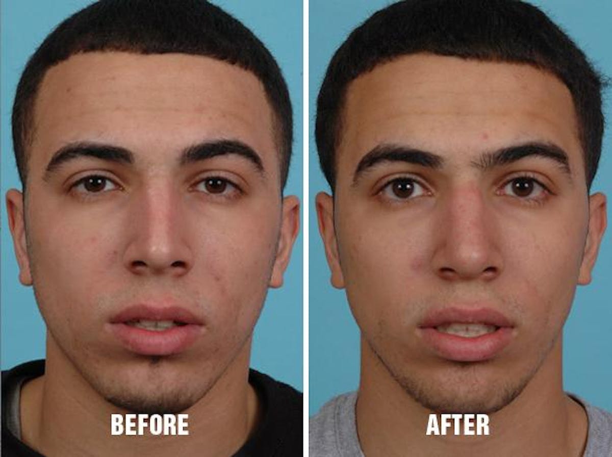 Rhinoplasty before and after, frontal.