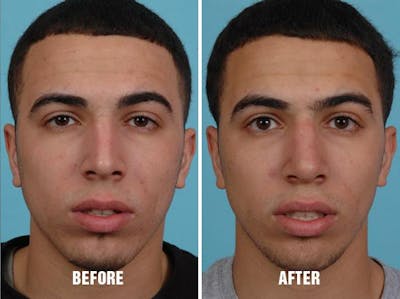 Rhinoplasty before and after, frontal.