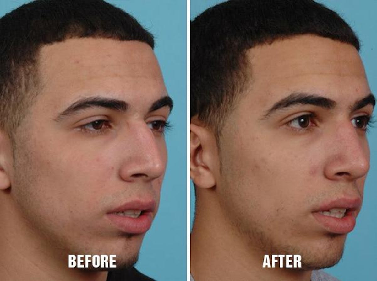 Rhinoplasty before and after, oblique right.