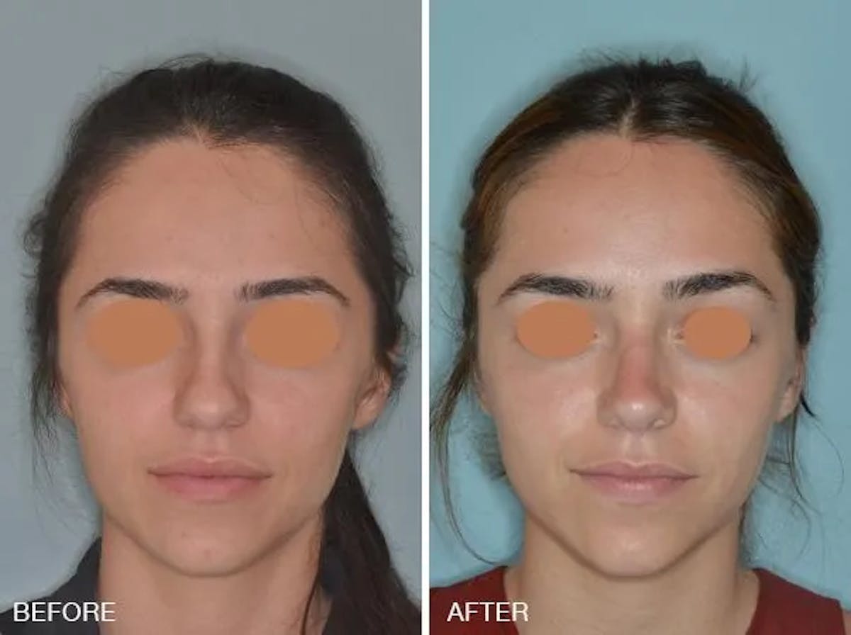 Rhinoplasty before and after, frontal.