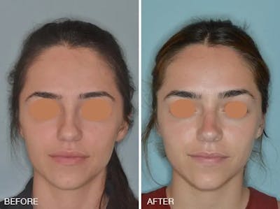 Rhinoplasty before and after, frontal.