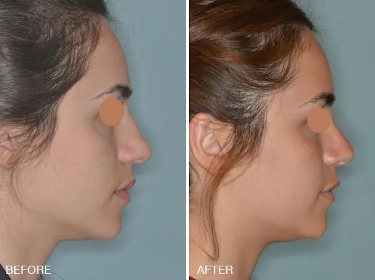 Rhinoplasty before and after, lateral right.