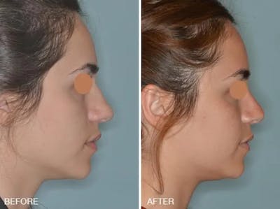 Rhinoplasty before and after, lateral right.