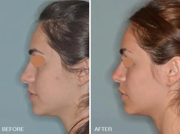 Rhinoplasty before and after, lateral left.