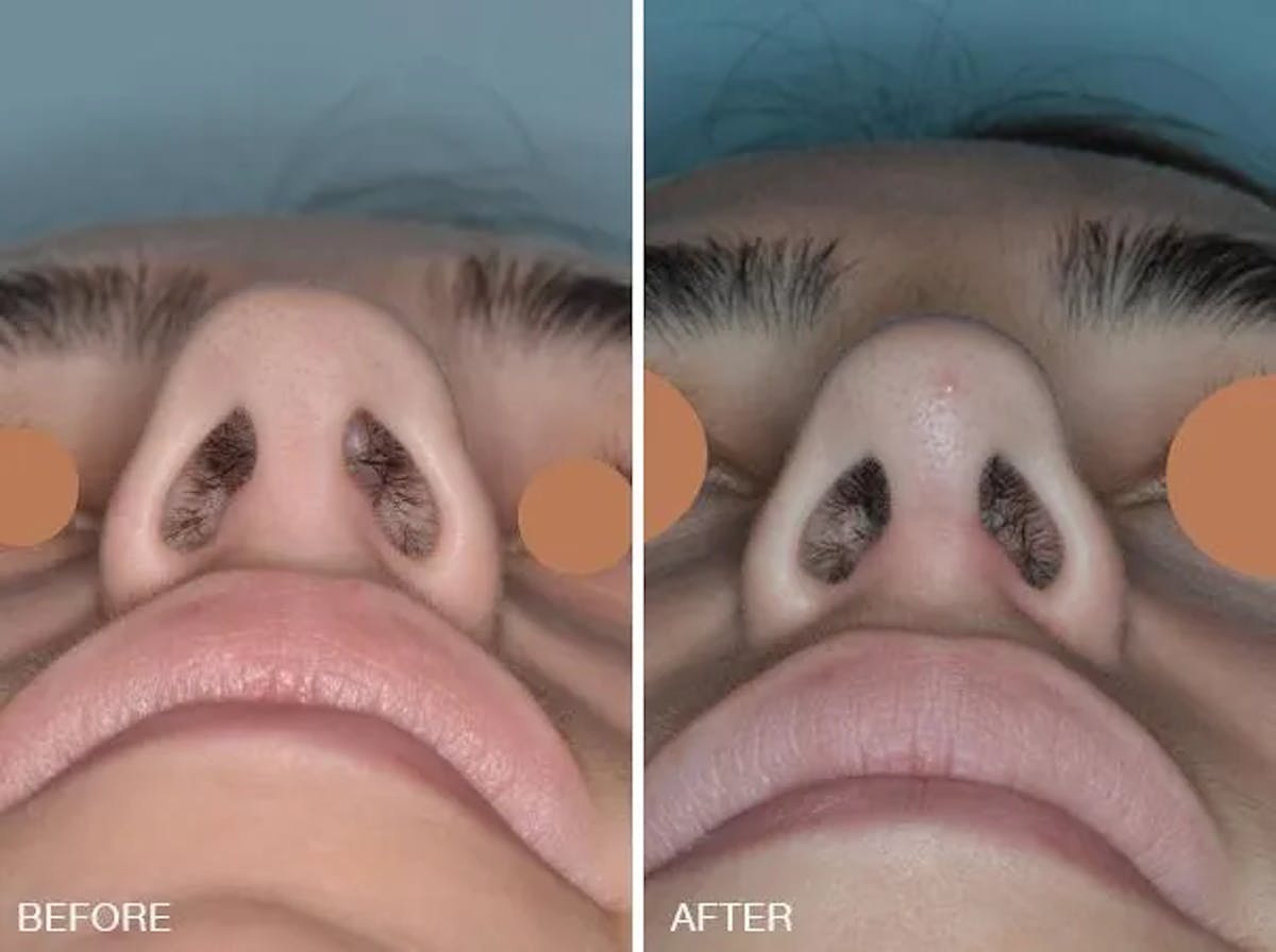 Rhinoplasty before and after, frontal.