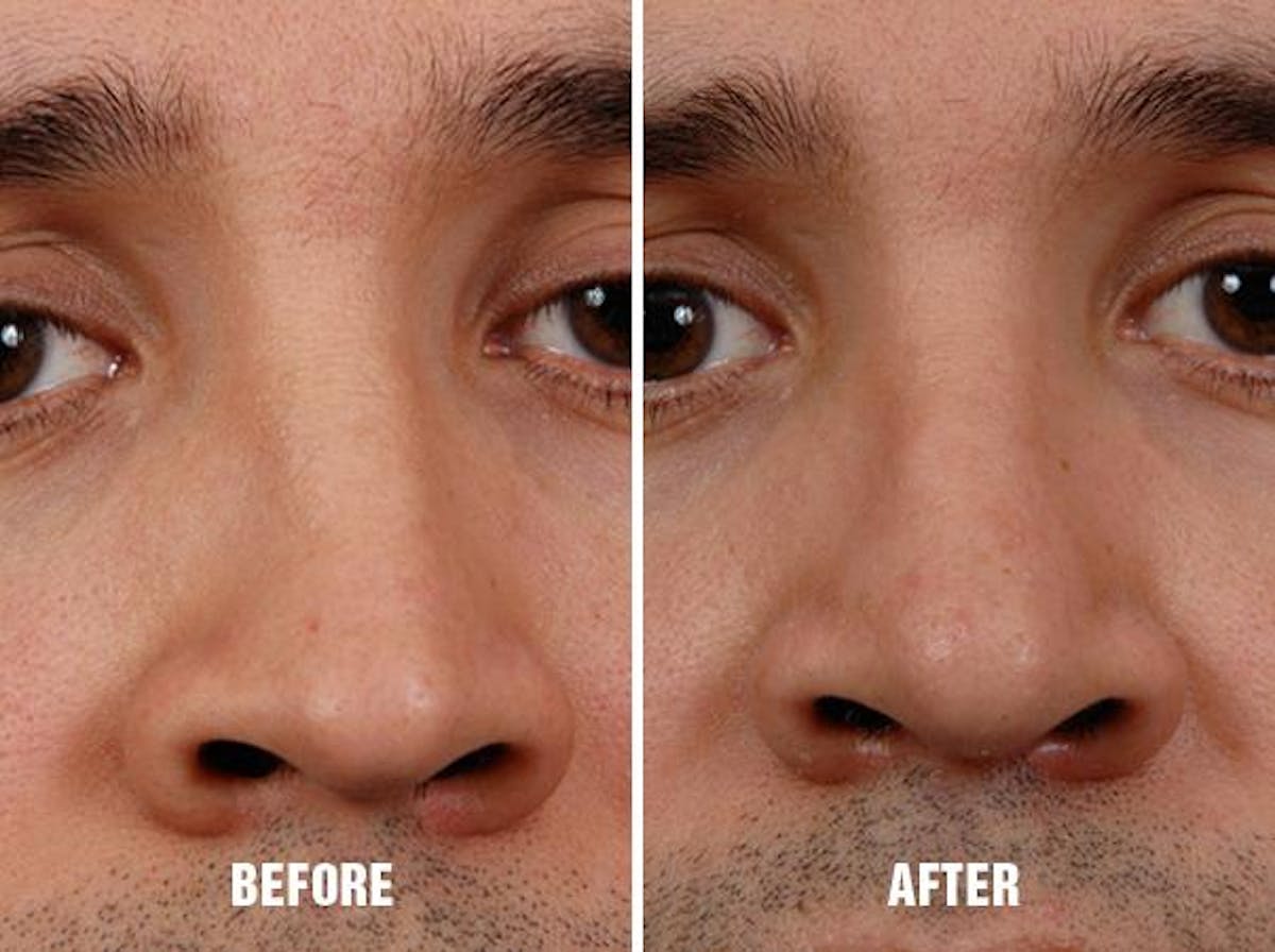 Rhinoplasty before and after, frontal.