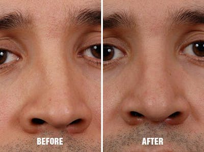 Rhinoplasty before and after, frontal.