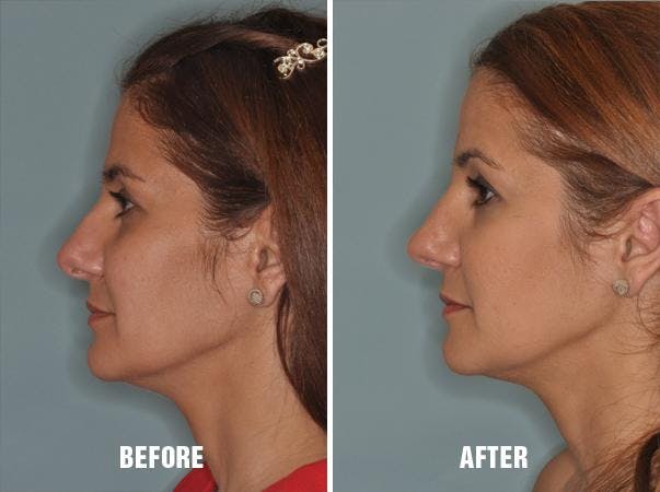 Rhinoplasty before and after, lateral left.