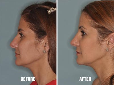 Rhinoplasty before and after, lateral left.