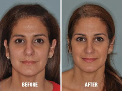 Rhinoplasty before and after, frontal.