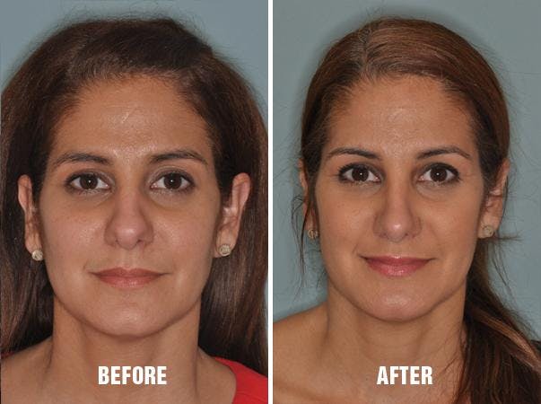 Rhinoplasty before and after, frontal.