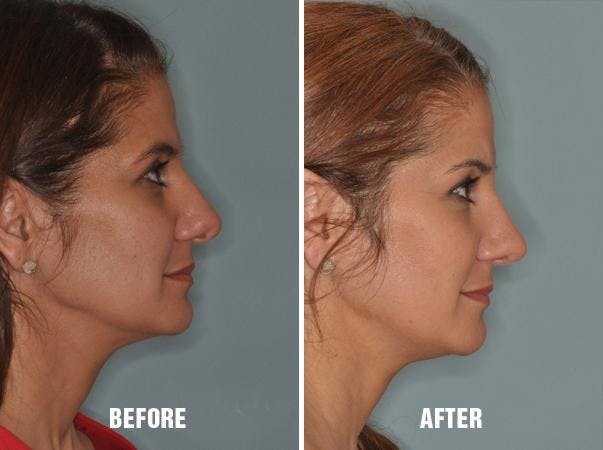 Rhinoplasty before and after, lateral right.