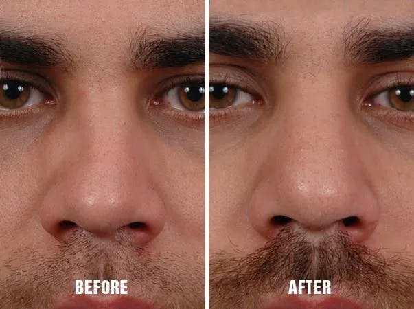 Rhinoplasty before and after, frontal.