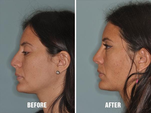 Rhinoplasty before and after, lateral left.
