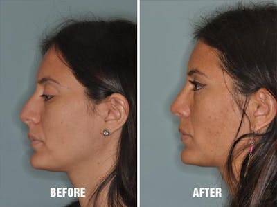 Rhinoplasty before and after, lateral left.