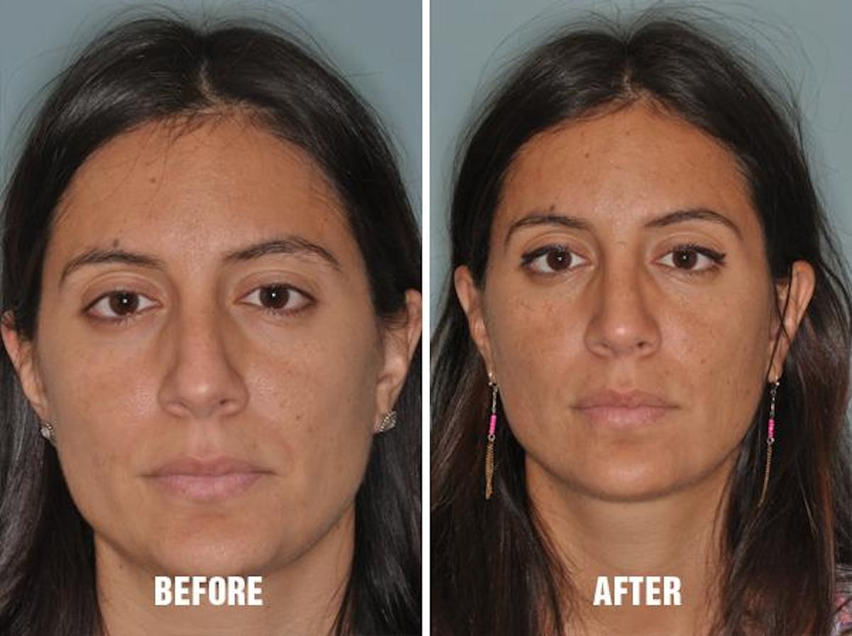 Rhinoplasty before and after, frontal.