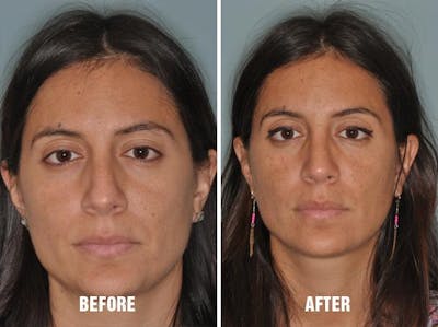 Rhinoplasty before and after, frontal.