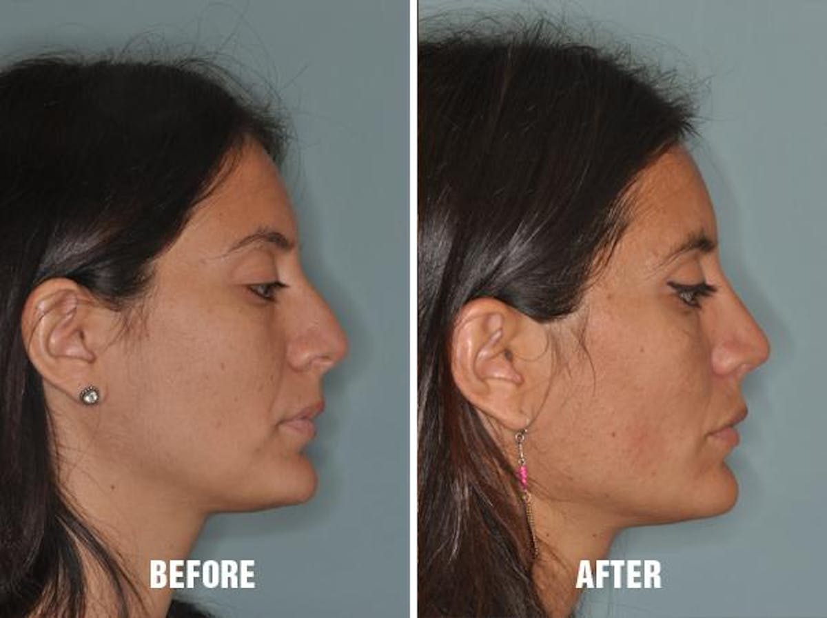 Rhinoplasty before and after, lateral right.
