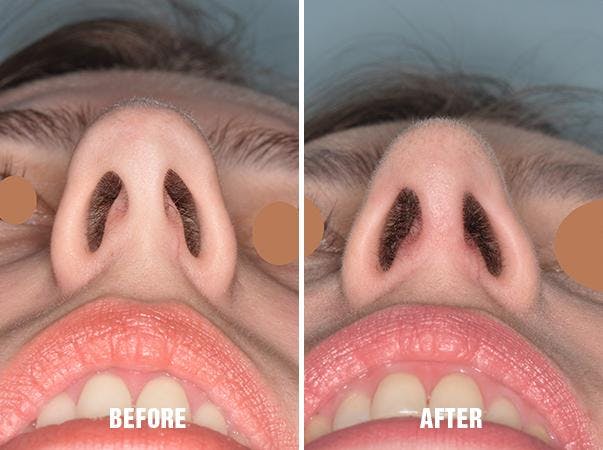 Rhinoplasty before and after, frontal.