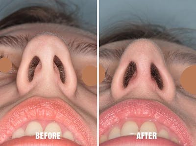 Rhinoplasty before and after, frontal.