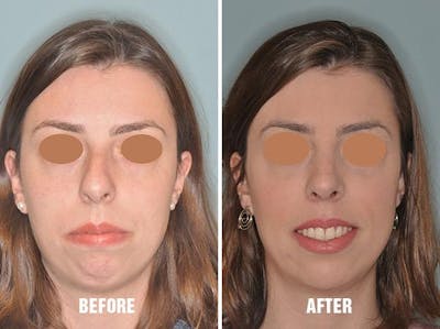 Rhinoplasty before and after, frontal.