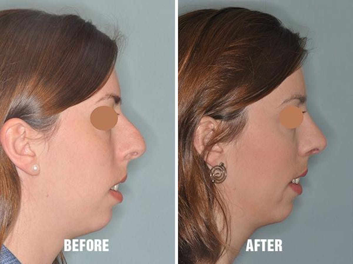 Rhinoplasty before and after, lateral right.