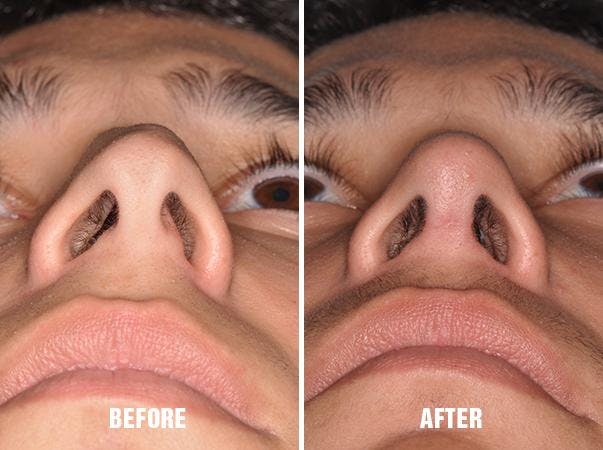 Rhinoplasty before and after, frontal.