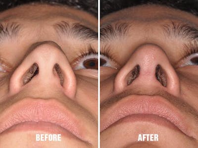 Rhinoplasty before and after, frontal.