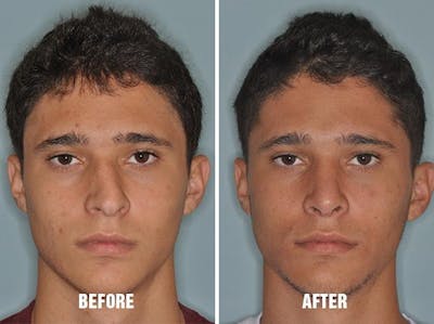 Rhinoplasty before and after, frontal.