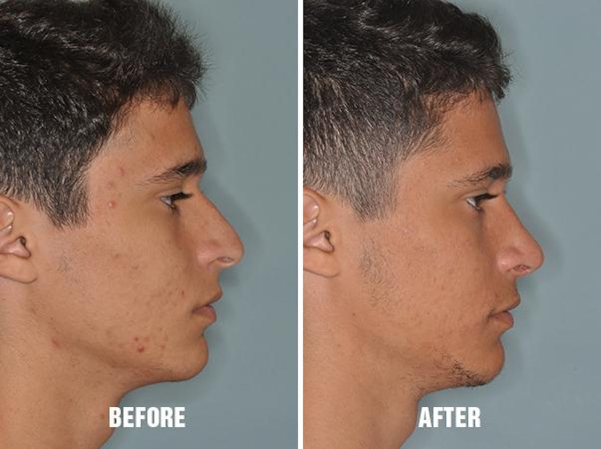 Rhinoplasty before and after, lateral right.