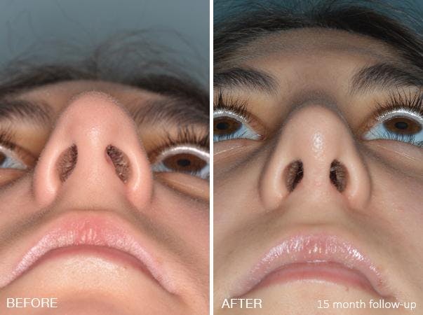 Rhinoplasty before and after, frontal.