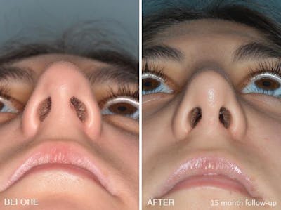 Rhinoplasty before and after, frontal.