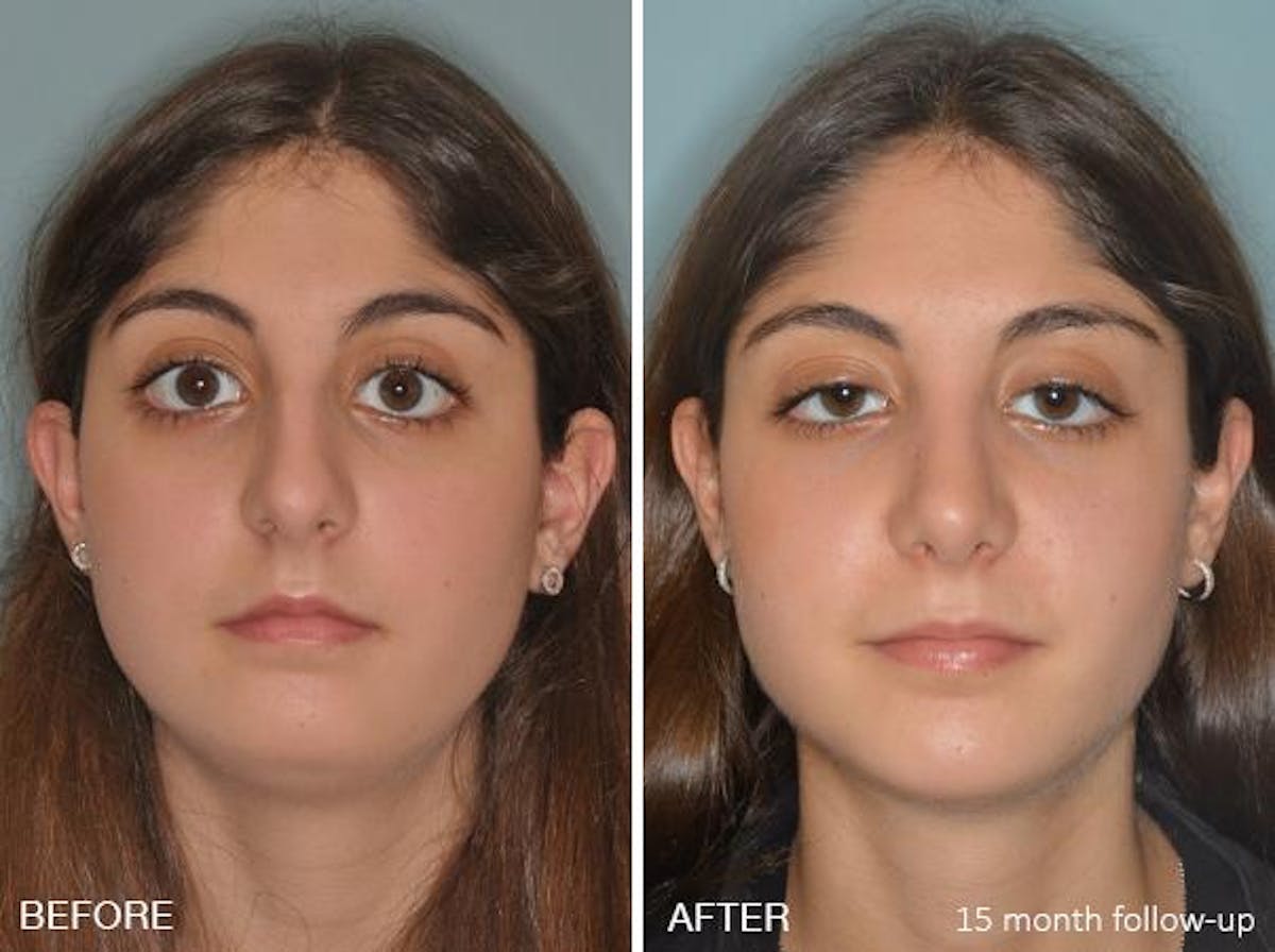 Rhinoplasty before and after, frontal.