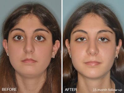Rhinoplasty before and after, frontal.