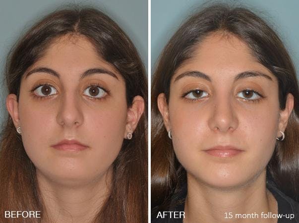 Rhinoplasty before and after, frontal.