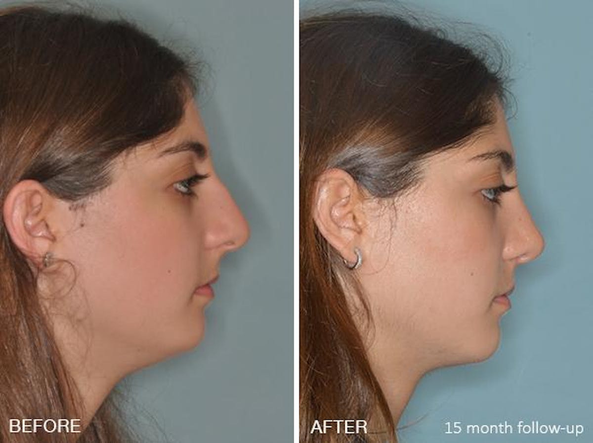Rhinoplasty before and after, lateral right.