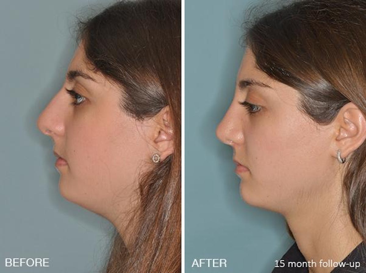 Rhinoplasty before and after, lateral left.