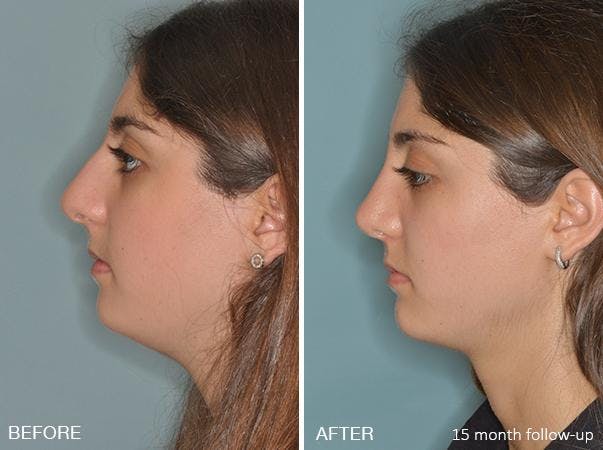 Rhinoplasty before and after, lateral left.