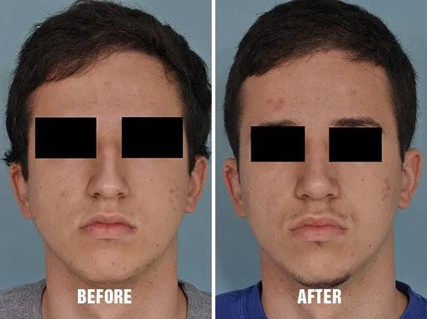 Rhinoplasty before and after, frontal.