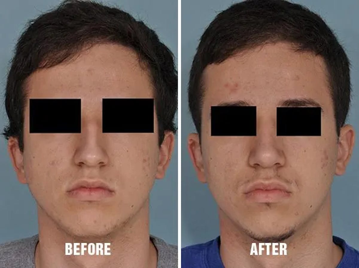 Rhinoplasty before and after, frontal.