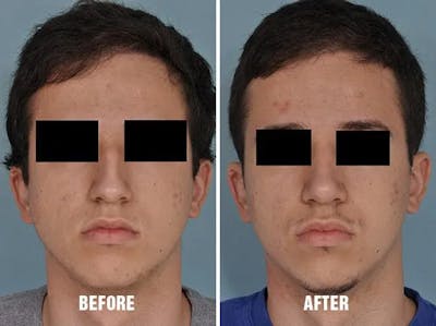 Rhinoplasty before and after, frontal.