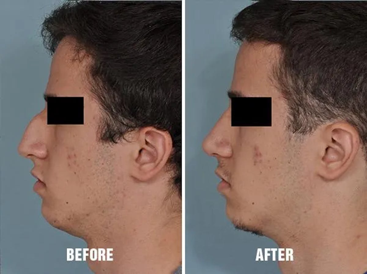 Rhinoplasty before and after, lateral left.