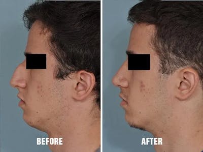 Rhinoplasty before and after, lateral left.