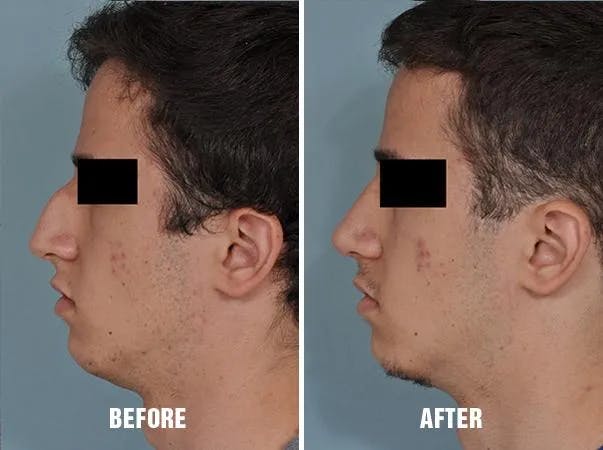 Rhinoplasty before and after, lateral left.