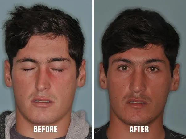 Rhinoplasty before and after, frontal.