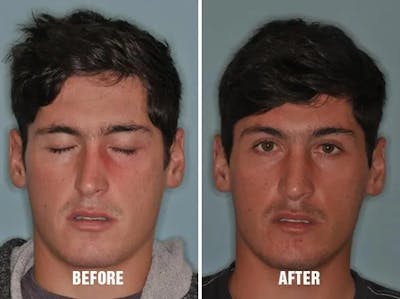 Rhinoplasty before and after, frontal.
