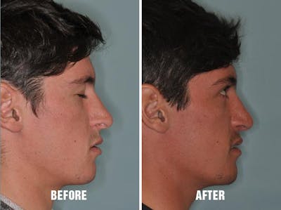 Rhinoplasty before and after, lateral right.